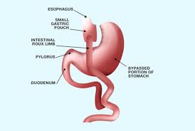 Oebb Bariatric Surgery Baby barbie stomach surgery операция на желудке малышки барби. oebb bariatric surgery