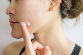 Hướng dẫn bôi thuốc trị mụn đúng cách | Vinmec