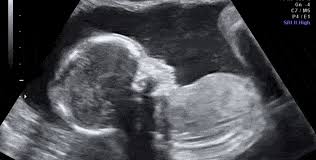 Sementara gambar 10c adalah gambar. Gambar Usg Janin Perempuan Gambar Cewek Buat Quotes