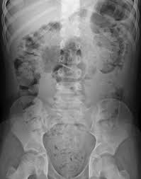 Image result for Pediatric Constipation