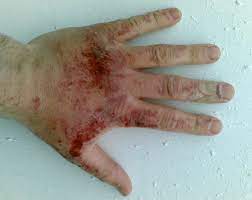 Chemical Burns: Symptoms, Diagnosis, And Treatment