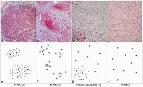 Plos One Nodular Lymphocyte Predominant Hodgkin Lymphoma And T Cell Histiocyte Rich Large B Cell Lymphoma Endpoints Of A Spectrum Of One Disease