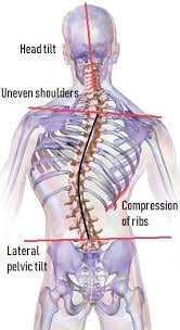 Scoliosis Exercises Improve Your Alignment Posture Direct Scoliosis Scoliosis Exercises Scoliosis Surgery