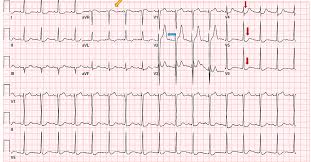 Image result for Transfusion Associated Circulatory Overload