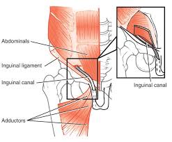 Hernias usually present as swelling accompanied by pain or a dragging sensation in the groin. Sports Hernia Athletic Pubalgia Orthoinfo Aaos