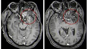 Doctors explain how to tell if you have a head cold or something more serious that requires medical attention, such as the flu, strep throat, meningitis, or mono. Unusual Treatment Shows Promise For Kids With Brain Tumors Asharq Al Awsat