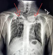 Chest Xray Severe Changes From Chronic Tuberculosis Radiologist Radiology Cough This Information Is For Protected Health Information Radiology Medical
