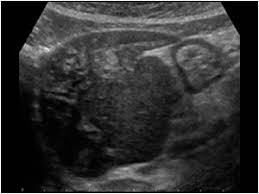 Ultrasound is not different from normal (audible) sound in its physical properties, except that humans cannot hear it. 1 1 15 Hepatitis Ultrasound Cases