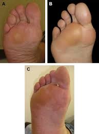 Transfer Metatarsalgia Post Hallux Valgus Surgery