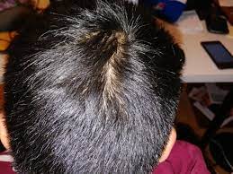 Am I Balding Or Is It Just A Really Bad Cowlick Tell Me The Truth Please Hair Beauty Skin Deals Me Fashion Love Cute St Cowlick Am I Balding Balding