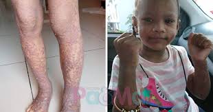 Penyakit kulit yang biasa dijumpai tetapi kurang difahami. Tia Alami Severe Eczema Paling Sedih Sampai Kena Berhenti Belajar Di Tadika Pa Ma
