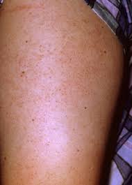 Image result for Keratosis pilaris