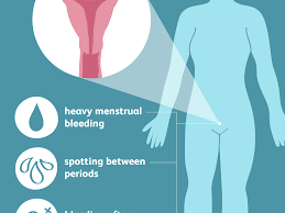The cells that line the womb; The Symptoms Of Uterine Polyps
