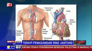 Terapi Pemasangan Ring Jantung Youtube