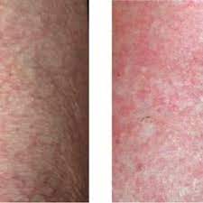 The xerosimeter is a tool developed in an effort to facilitate patient management and for training purposes. Pdf Diagnosis And Treatment Of Xerosis Cutis A Position Paper