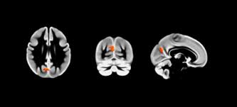 This is so because its function is more general and essential, and has to do with the basic functioning of the nervous system. Night Owls Have More Grey Matter In Their Brains Than Early Birds