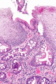 File Esophagus With Intestinal Metaplasia Intermed Mag Jpg Libre Pathology Celulas Biologia Patologia