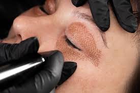 Plasma Skin Tightening All You Need To Know About Wrinkle Remedies In 2020 Skin Tightening Treatments Skin Tightening Wrinkle Remedies