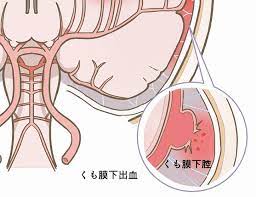 Jun 30, 2021 · くも膜下出血によって、アルツハイマー型認知症になりましたなんてまず有り得ない。仮に認知症だとしても、この女性の行動から見て、アルツハイマー型なんて診断されないだろう。 他の人も言っているが、高次脳機能障害と見るべきだろう。 ãã‚‚è†œä¸‹å‡ºè¡€ã®å‰å…† åŽŸå›  ç—‡çŠ¶ æ¨ªæ¿±ã‚‚ãˆãŽé‡Žã‚¯ãƒªãƒ‹ãƒƒã‚¯ é'è'‰åŒº é'è'‰å°