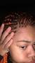 Itchy Bumps From Braids