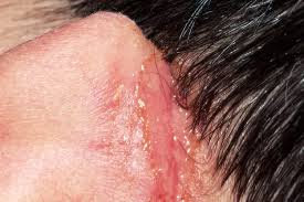 Image result for ekzema face