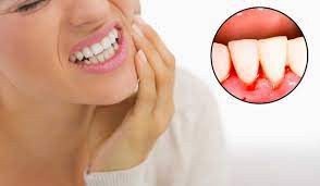 Bleeding Gums Can Be An Important Warning Bleeding Is The Main Indicator Of Boneloss And Or Systemic Cosmetic Dentistry Dental Implants Cost Dental Health
