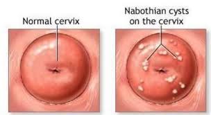 Nabothian Cyst Picture Cysts Cervix Hysterectomy
