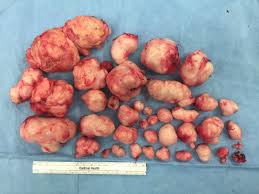Apa saja gejala fibroid rahim tersebut? Fibroid Ketumbuhan Paling Kerap Berlaku Pada Rahim Yang Boleh Membahayakan Iluminasi