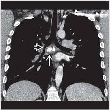 Image result for Broncholithiasis