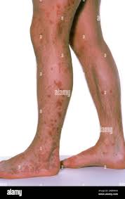 Image result for Cimex lectularius bites