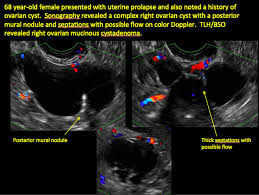 While a transvaginal ultrasound can help find a mass on a woman's ovary, it can't tell whether that mass is cancerous or benign (i.e. Imaging The Suspected Ovarian Malignancy 14 Cases Mdedge Obgyn