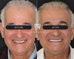 ➡️ Swipe to see a full-mouth transformation like no other! This patient  came to Smile Boutique ready for a change and with a complete set of  All-on-X dental implants, Dr. Stan helped