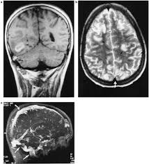 A retrospective study of seven cases. Mr Angiographic Diagnosis Of Cerebral Venous Sinus Thrombosis Following Allogeneic Bone Marrow Transplantation Bone Marrow Transplantation