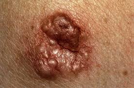 Not all skin cancers look the same. Basal Cell Carcinoma Amboss