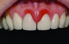 Image result for Gingivitis