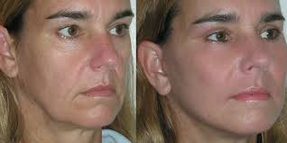 In addition, if your haircolor is too dark, you can actually emphasize the look of lines, wrinkles and sagging/bags in the face. Droopy Jowls Nefertiti Lift Advanced Cosmetic Medicine