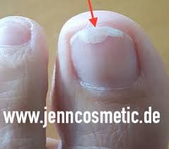 Fussnagel Lost Sich Einfache Methode Fussnagelpilz Finger Nagelpilz