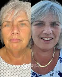 💫 ¿Te gustaría lucir más joven y fresca? Entonces el Facelift es para ti  💉✨ Este procedimiento es ideal si buscas un rejuvenecimiento facial  natural, sin perder tu esencia y con resultados
