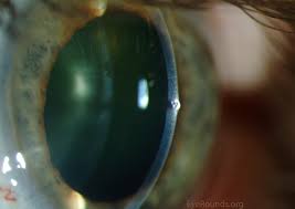 Image result for Eye Foreign Body