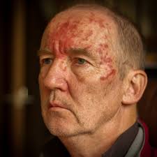 What is PACT therapy? PACT is an abbreviation and scientific term that  stands for Photodynamic Antimicrobial Therapy. This treatment has been used  effectively in medicine since the 1990s for the treatment of