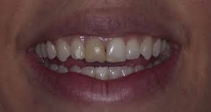 Others have something else in mind. Zirconia Veneers In Los Angeles Dental Veneers Dr Anthony Mobasser