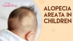 A healthy diet combats nutritional deficiencies which are a primary cause of hair fall in children. Alopecia Reasons For Ways To Treat Hair Loss In Toddlers