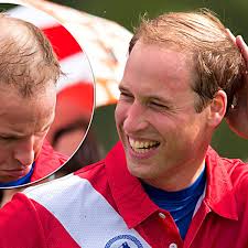 Auch nicht, wenn es um ihre geliebte mutter, prinzessin diana, geht. Prinz William Die Glatze Ist Ihm Sicher Bunte De