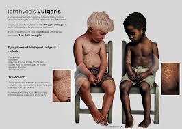 Image result for Ichthyosis