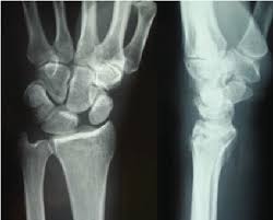 Image result for Scapholunate Dislocation
