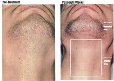 Laser hair removal for men has finally come of age. 10 Laser Hair Reduction Ideas Laser Hair Reduction Hair Reduction Laser Hair Removal