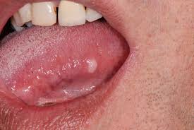 Image result for white cancer on tongue)