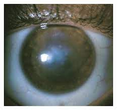 Severe Keratitis Caused By Pseudomonas Aeruginosa Successfully Treated With Ceftazidime Associated With Acetazolamide