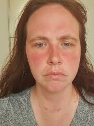 Here are some of my symptoms, trying to make a list for my doctor. Aching  all over random pains random places I can touch a balloon all day but a  bandaid leaves