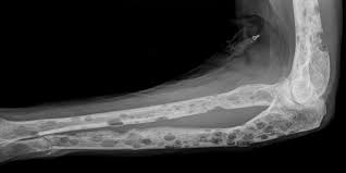 Bone marrow is a thick liquid inside your bones. University Of Leeds News Health New Trial For Bone Marrow Cancer Patients Facing Poor Outcomes